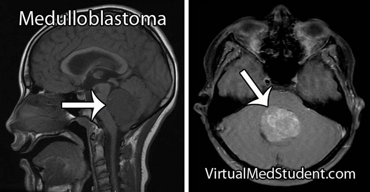U nguyên bào tủy - Hình ảnh minh họa